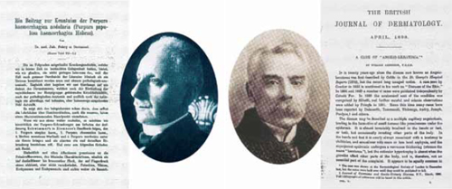 Рис. 3. (a) Джон Фабри (1860—1930) и его публикация, посвященная болезни Фабри; (б) Вильям Андерсон (1842—1900) и его статья