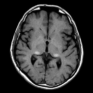 Рис. 11. МРТ головного мозга: T1-взвешанное аксиальное изображение