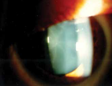 Рис. 18. Задняя субкапсулярная катаракта (спицеообразная катаракта, катаракта Фабри)