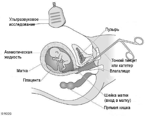 Трансвагинальный забор материала (через шейку матки)