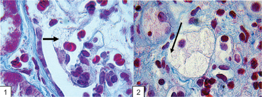 Световая микроскопия клеток клубочка и тубулярного эпителия. Мелковакуолярная цитоплазма подоцитов и тубулярного эпителия (черные стрелки), содержащая множество небольшого размера прозрачных Шифф-негативных гранул, которые напоминают «пенистое» перерождение клеток (окраска трихром Х600).