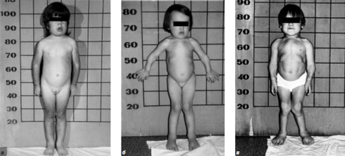 Рис. 1. а – ребенок 8 лет с VI типом мукополисахаридоза (синдром Марото-Лами), б – девочка 4 лет с синдромом Моркио А, в – девочка 15 лет с синдромом Гурлер-Шейе