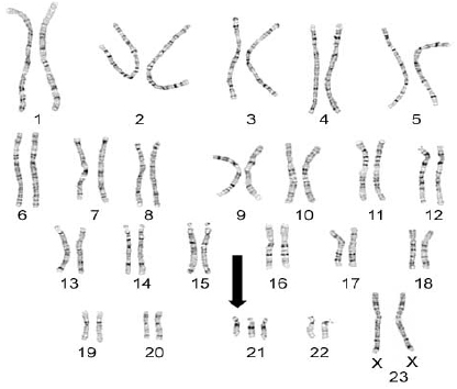 Рисунок 3. Хромосомы девочки (последняя пара хромосом XX) с синдромом Дауна. Видны три копии 21-ой хромосомы вместо двух.